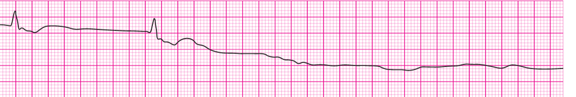 Asystole | Time of Care