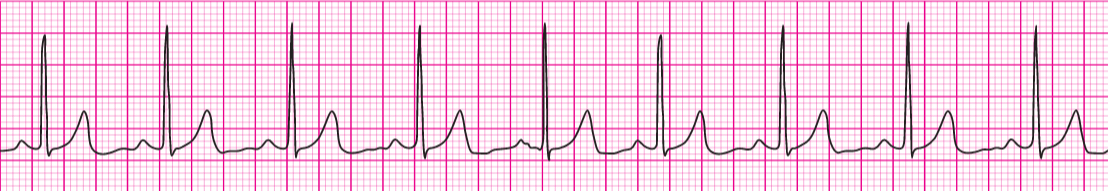 Normal Sinus Rhythm 