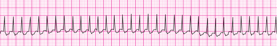 Supra ventricular Tachycardia (SVT) | Time of Care