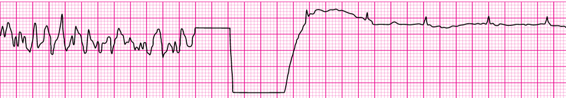 VF with Successful defibrillation and Resumption of Organized rhythm ...